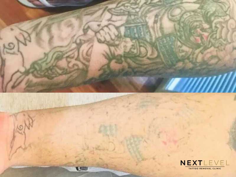 Tattoo Removal Results After