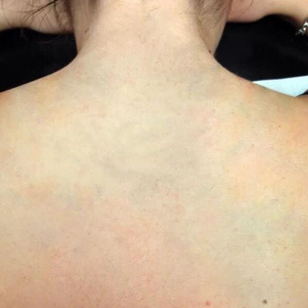 Woman's back showing the results of a laser tattoo removal